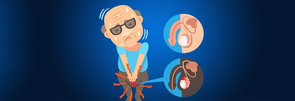 Testicular Pain Treatment i