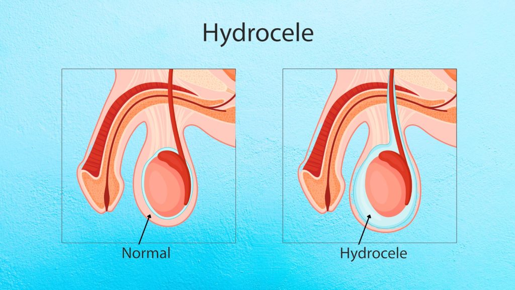 Hydrocele