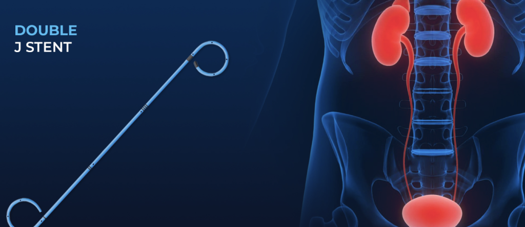 Double J (DJ) Stent Placement: