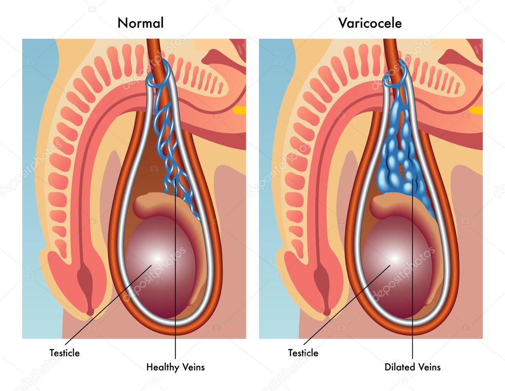 Varicocele Treatmen