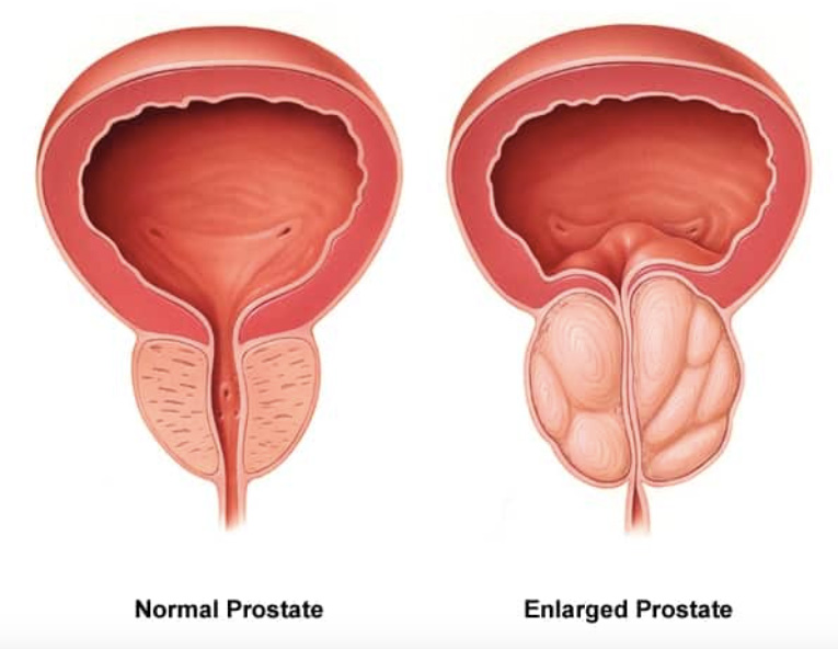 Enlarged Prostate