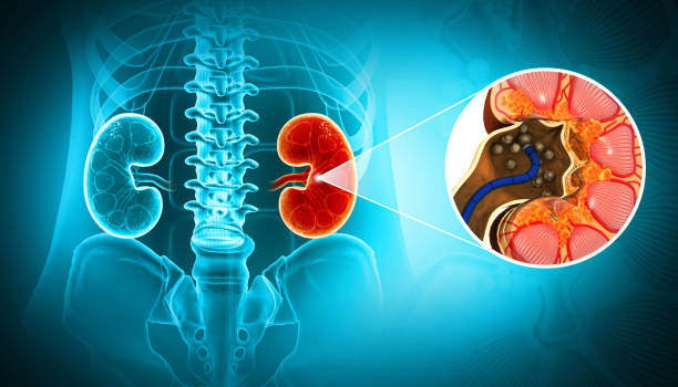kidney stone treatment