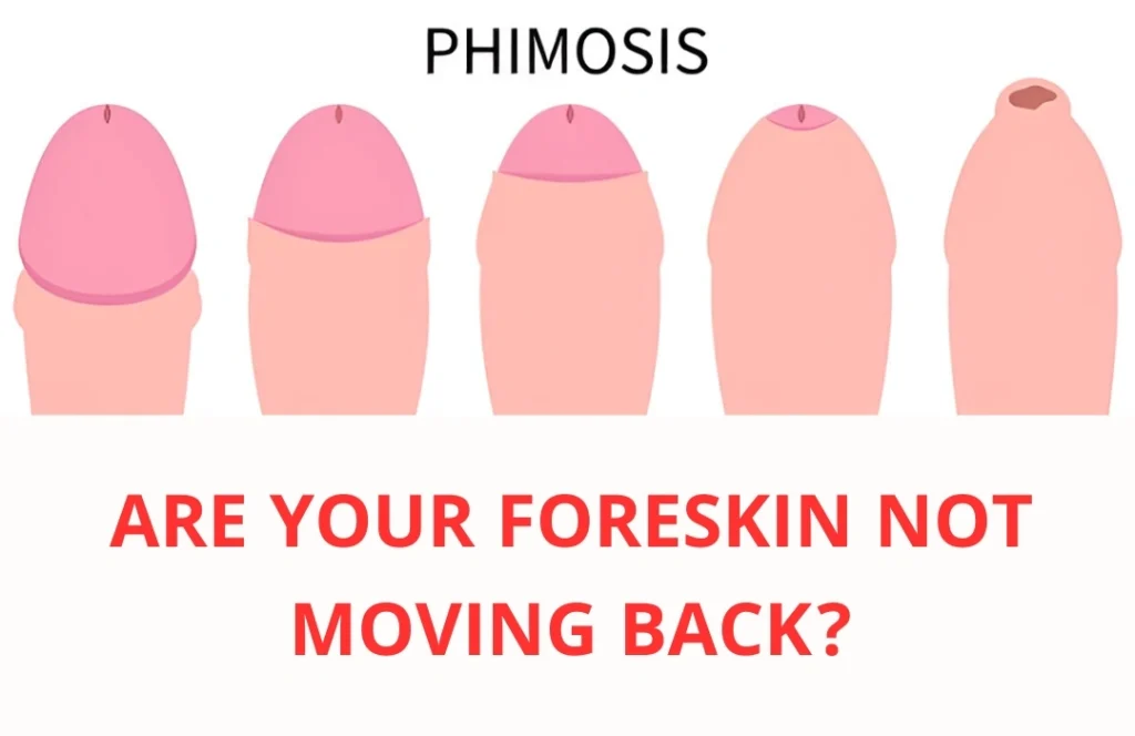 Tight Foreskin Treatment